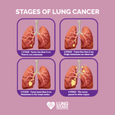 Lung Cancer - Lung Injuries